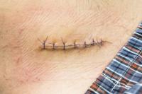 wound-detection project thumbnail