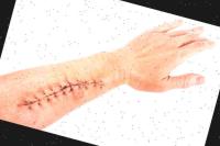 surgical-wound-classification project thumbnail